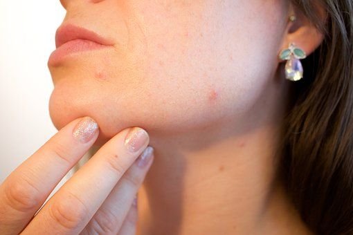 Acne, Female Face